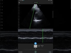 256 Scan Lines Ipad Ultrasound Transducer Wireless Ultrasound Probe For PICC