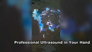 Portable Transvaginal Ultrasound for Modern Gynecology